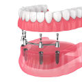 What is the most common complication of implants?