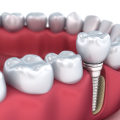Does a dental implant hurt more than a root canal?