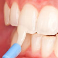 What is fluoride treatment?