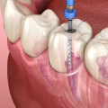 What is the easiest dental procedure?