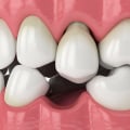 What is the best option for replacing missing teeth?