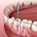 What causes you to need a root canal?