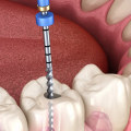 What exactly happens in a root canal?