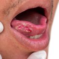 What are the signs of oral cancer?