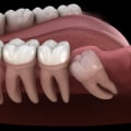 What are the different types of impaction?