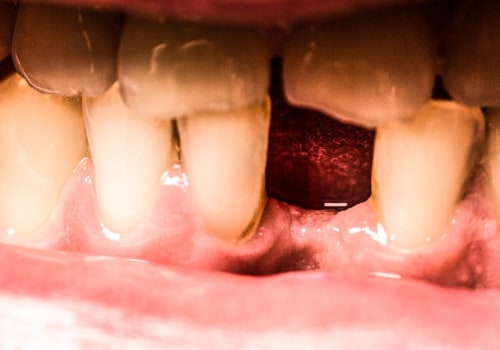 Treatments for Worn Down or Eroded Teeth Enamel