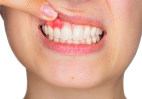 How can i prevent tooth decay naturally?