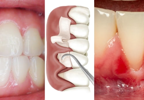 What is the latest treatment for receding gums?