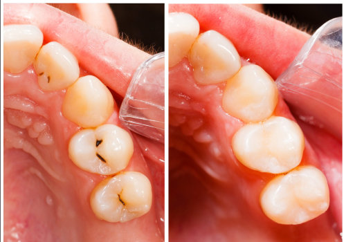 How long do fillings last for?
