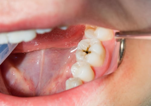 How can i tell if i have cavities?