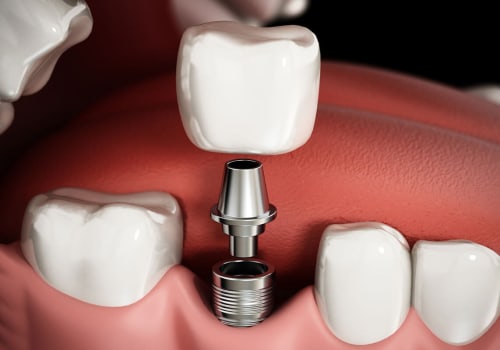 When should you not have a tooth implant?