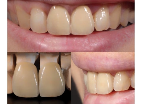 How does a tooth crown work?