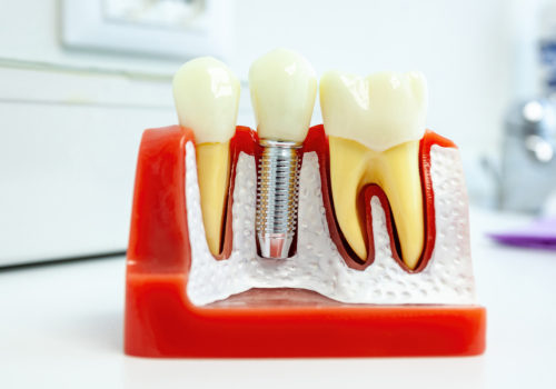 What is the most painful part of a dental implant?