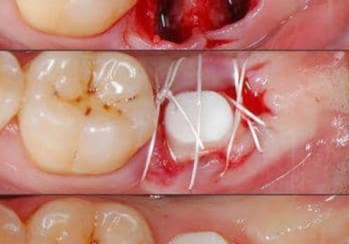 How bad is the pain from dental implant surgery?