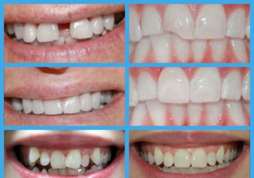 Is there another way to straighten teeth without braces?