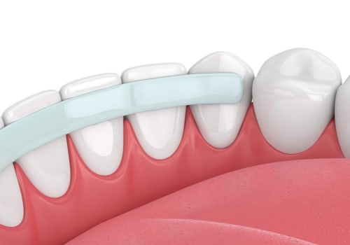 Can i get bonding using a cosmetic dental procedure?