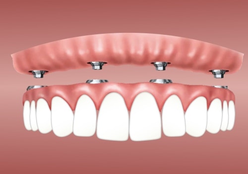 Is there a downside to implants?