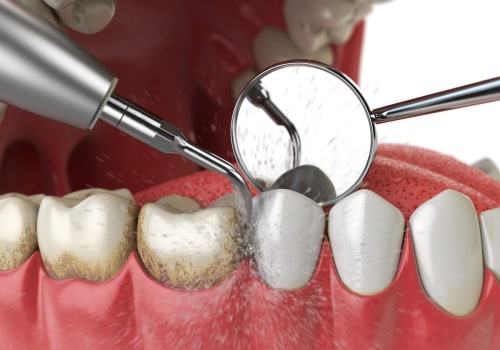 What is a dental cleaning?