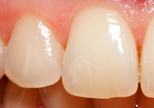 Can you restore worn enamel?