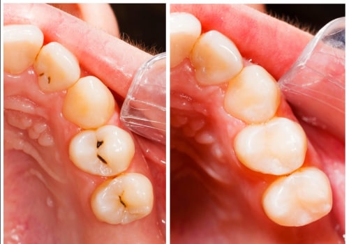 What is a filling on a tooth?