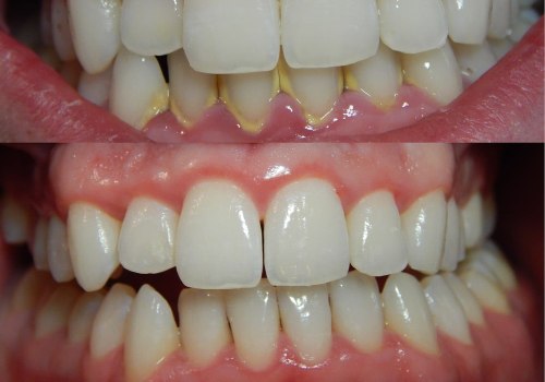 Can you stop gum disease once it starts?