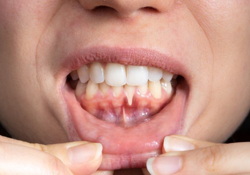 Can dentist repair receding gums?