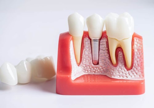 What is the best age for dental implants?