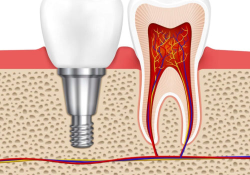 What don't they tell you about implants?