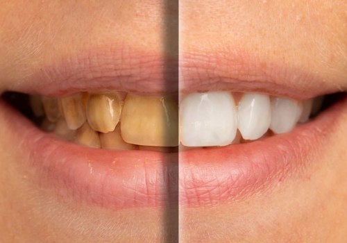 Can yellow teeth become white again?