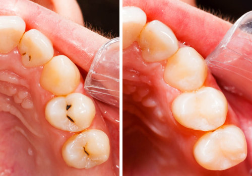 Do dentists or dental hygienists fill cavities?