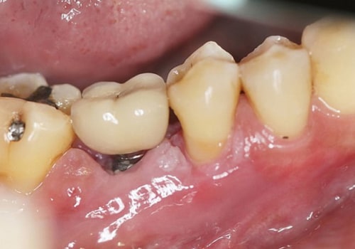 Which is the disadvantage for implants?