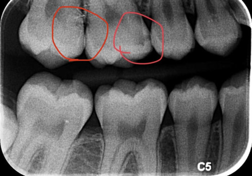 What is a dental x-ray?