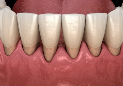 Is it ever too late to fix gum disease?