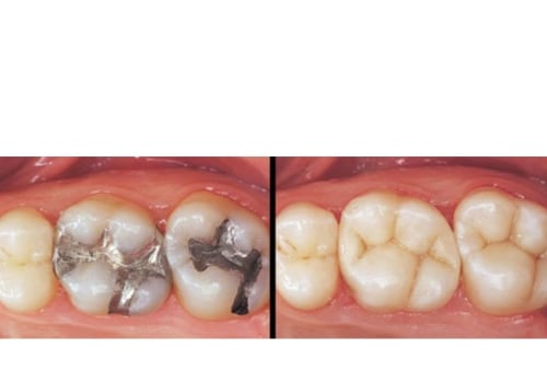 Can you 100% prevent cavities?