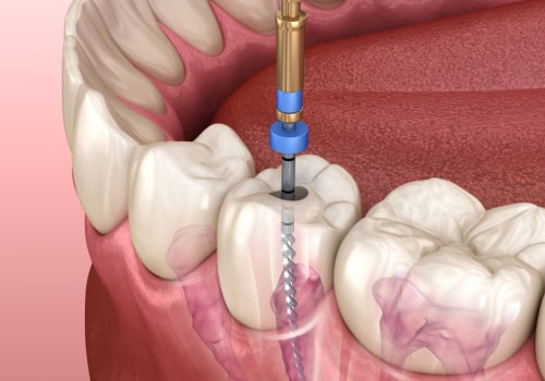 How painful is a root canal?