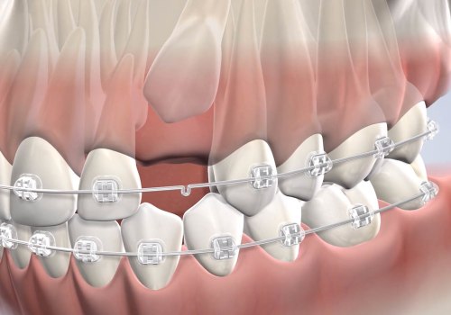 What are the treatment options for impacted teeth?