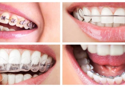 What are the different types of braces available for teeth straightening?