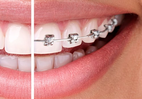 What is the difference between cosmetic and authentic braces?