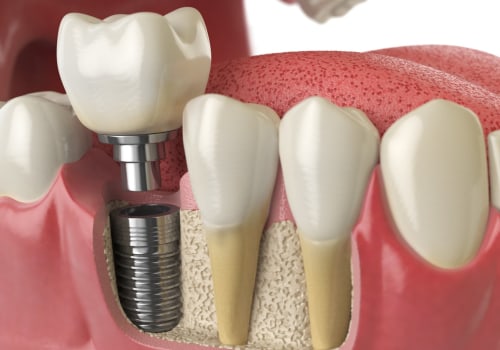 Is the first step in a dental implant painful?
