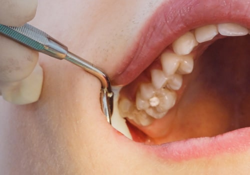 Can a dental hygienist perform a filling?