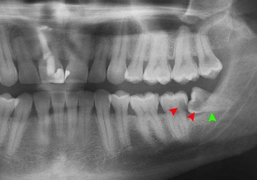 Treatments for Impacted Wisdom Teeth and Other Teeth in the Mouth