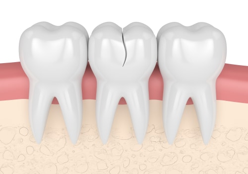 Are there any treatments available for cracked or chipped teeth?