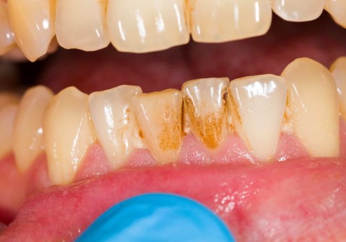How long can you go without teeth cleaning?