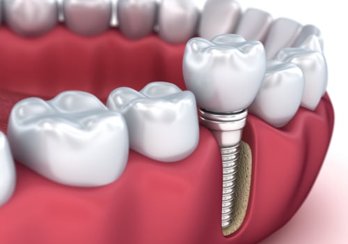 Does a dental implant hurt more than a root canal?