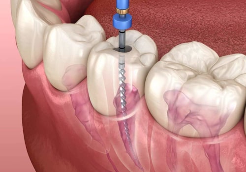 What is the easiest dental procedure?