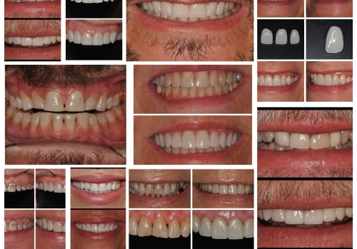 Is veneers a cosmetic procedure?