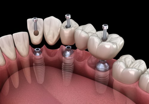 What can i get instead of dental implants?