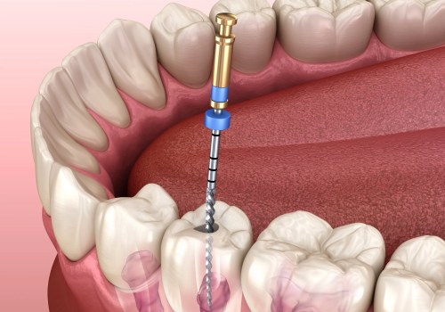 What causes you to need a root canal?