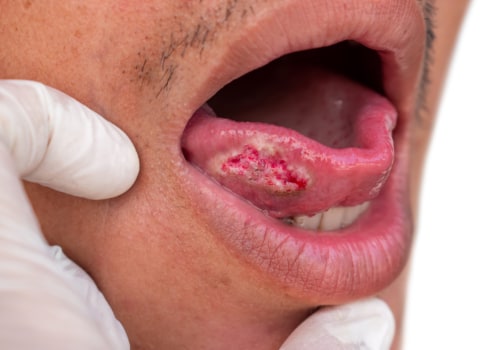 What are the signs of oral cancer?