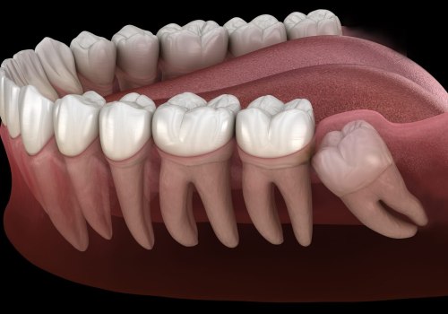 What are the different types of impaction?